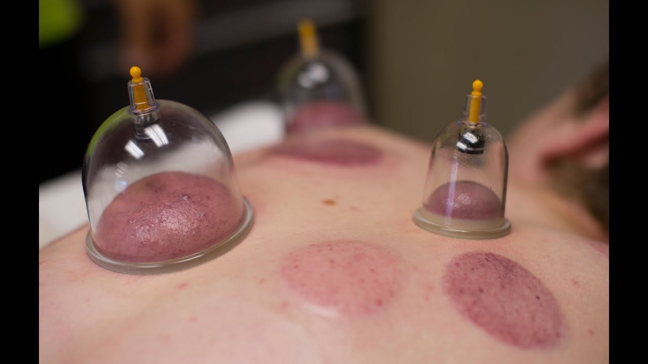 dry cupping… - An Alternative way to relieve muscle tension and increase blood flow.Learn More…