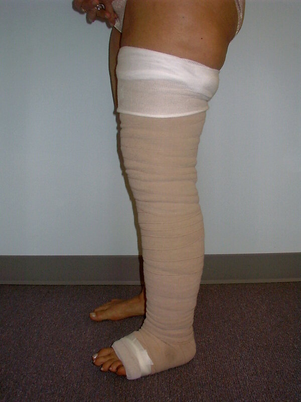 leg lymphoedema bandaging.jpg